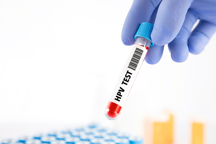 Genital Siğil Var Ama HPV Testi Negatif: Ne Anlama Geliyor?